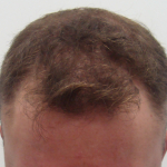 Before FUE- front